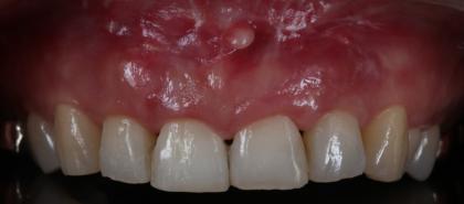 症例02 歯周組織再生療法および軟組織移植