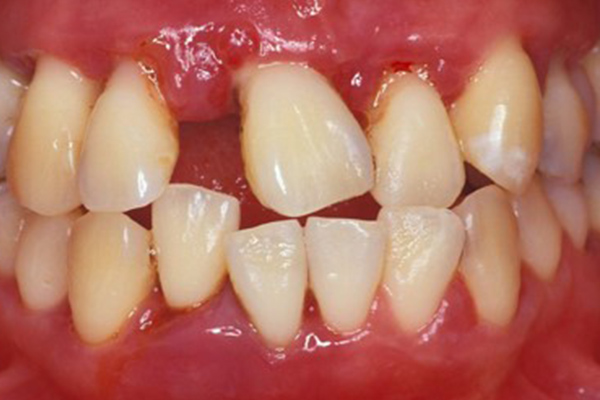 歯周病治療とインプラント実例 before