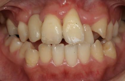 症例02 少数歯欠損症例（20歳・女性）