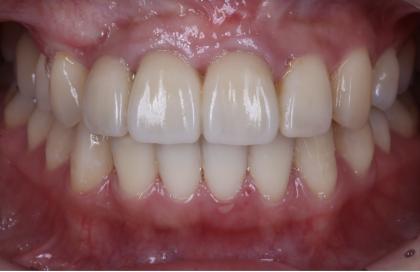 症例02 少数歯欠損症例（20歳・女性）