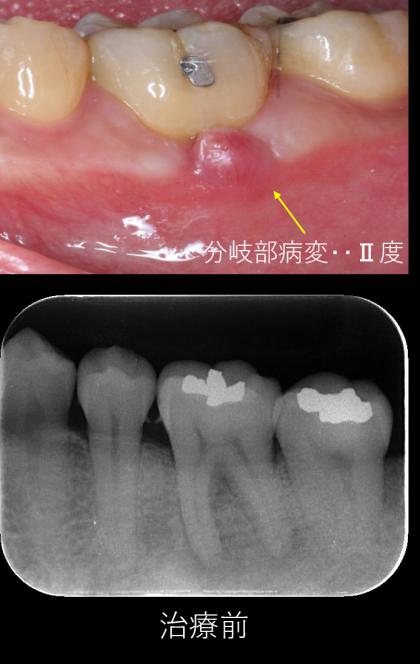 症例01 精密根管治療（53歳・男性）