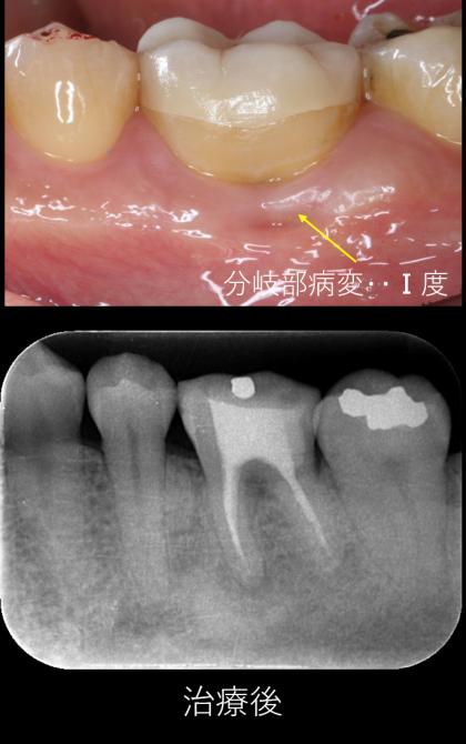 症例01 精密根管治療（53歳・男性）