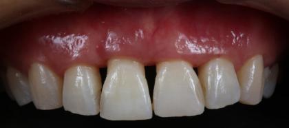 症例02 歯周組織再生療法および軟組織移植