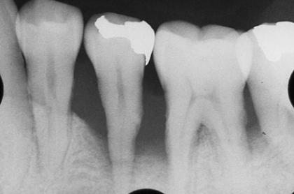 症例01 歯周組織再生療法（36歳・男性）