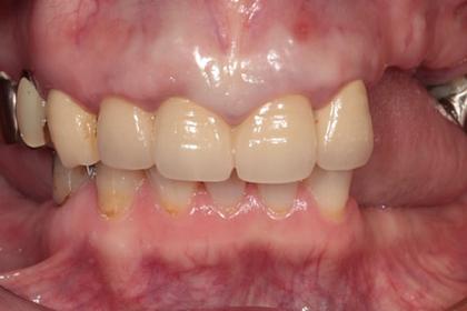 症例01 多数歯欠損症例（54歳・女性）