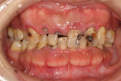 症例01 少数歯欠損症例（44歳・女性）