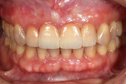 症例01 少数歯欠損症例（44歳・女性）