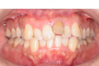 症例01 自家歯牙移植（39歳・女性）
