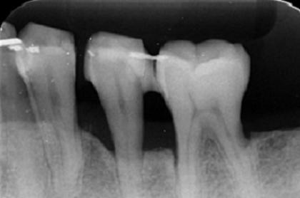 症例01 歯周組織再生療法（36歳・男性）