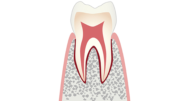 初期の虫歯