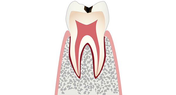 エナメル質の虫歯