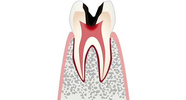 神経にまで達した虫歯