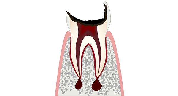 歯根だけが残った虫歯