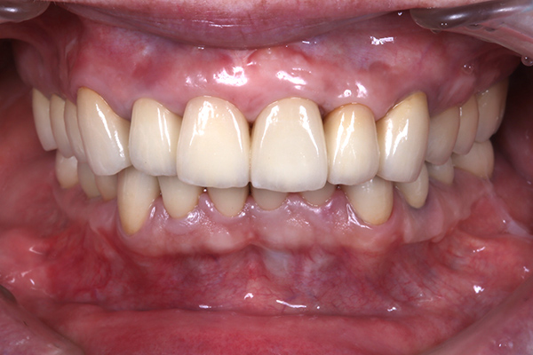 インプラント治療した歯とレントゲン写真 after