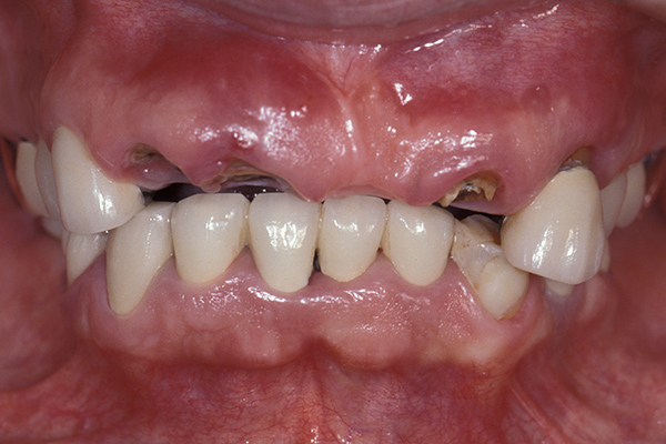 インプラント治療した歯とレントゲン写真 before