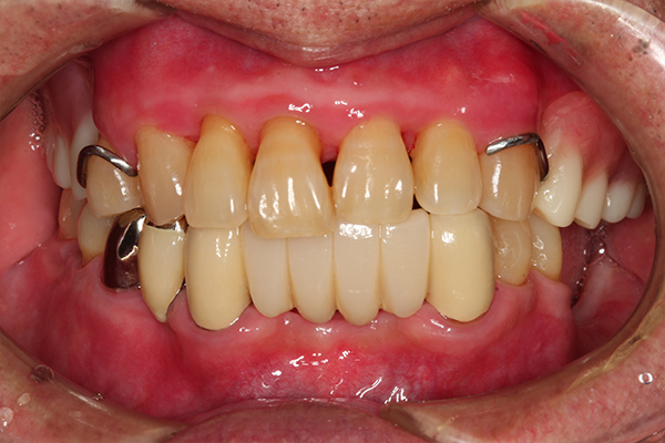 歯周病の基本治療とブラッシング指導 after