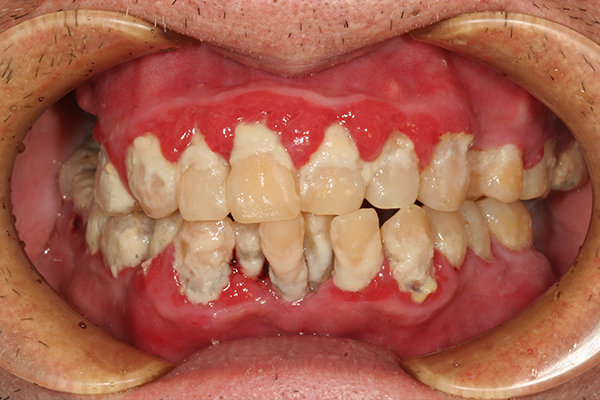 歯周病の基本治療とブラッシング指導 before