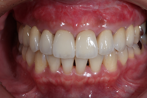 矯正と歯周形成外科を併用した治療例 after