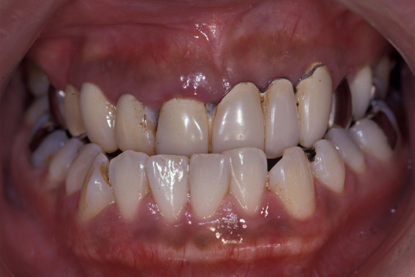 矯正と歯周形成外科を併用した治療例 before